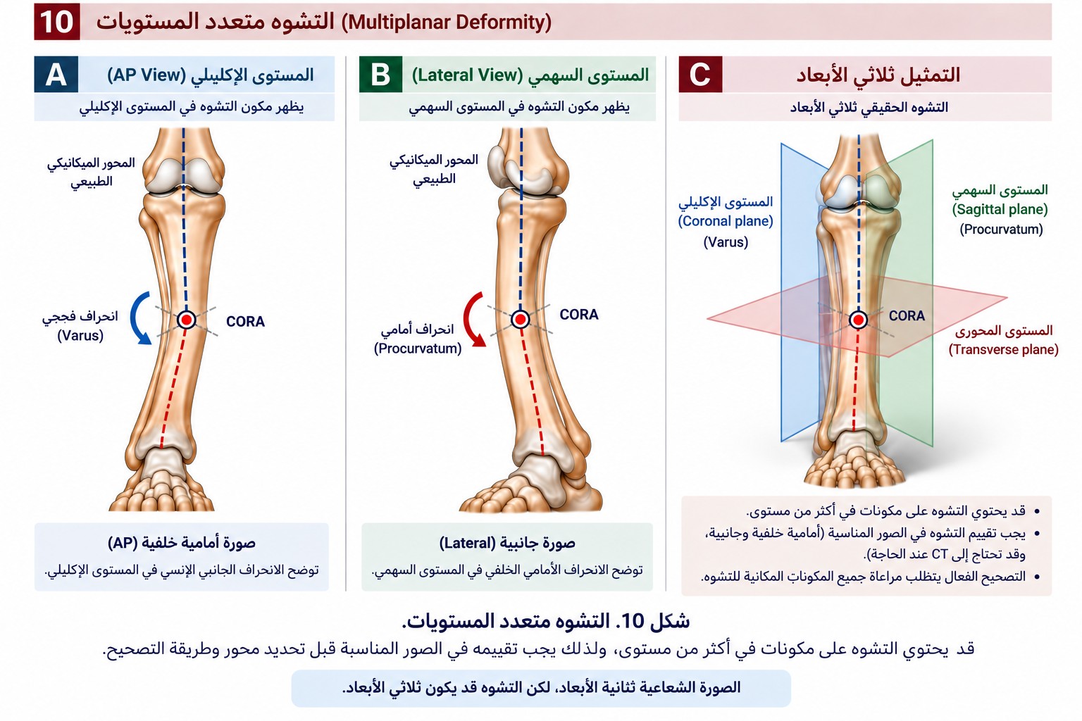التشوه متعدد المستويات في الصور الأمامية والجانبية وتمثيل ثلاثي الأبعاد