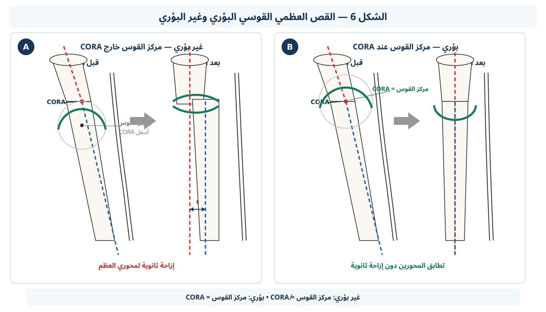 مقارنة القص القوسي غير البؤري والبؤري بالنسبة إلى CORA