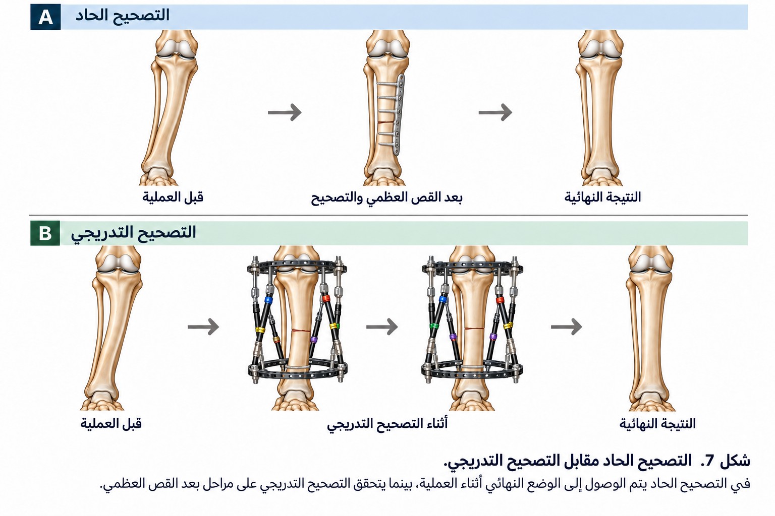 مقارنة التصحيح الحاد والتصحيح التدريجي بالمثبت الخارجي